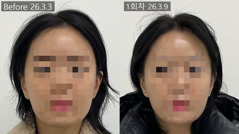 jaw-muscle-reduction 치료 사례 3 — 시술 전후 비교