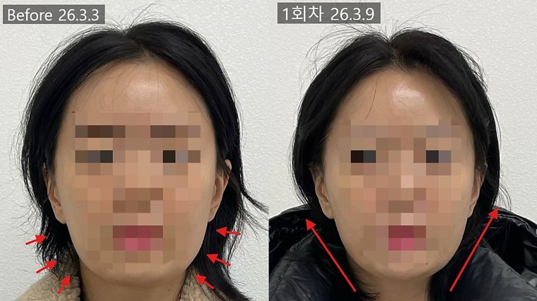 jaw-muscle-reduction 치료 사례 4 — 시술 전후 비교