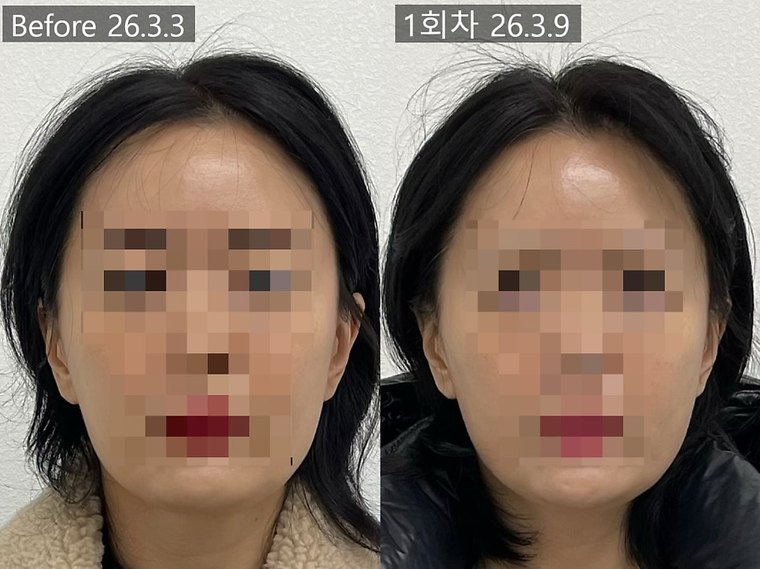 jaw-muscle-reduction 치료 사례 5 — 시술 전후 비교