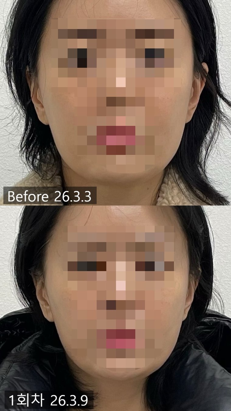 jaw-muscle-reduction 치료 사례 6 — 시술 전후 비교