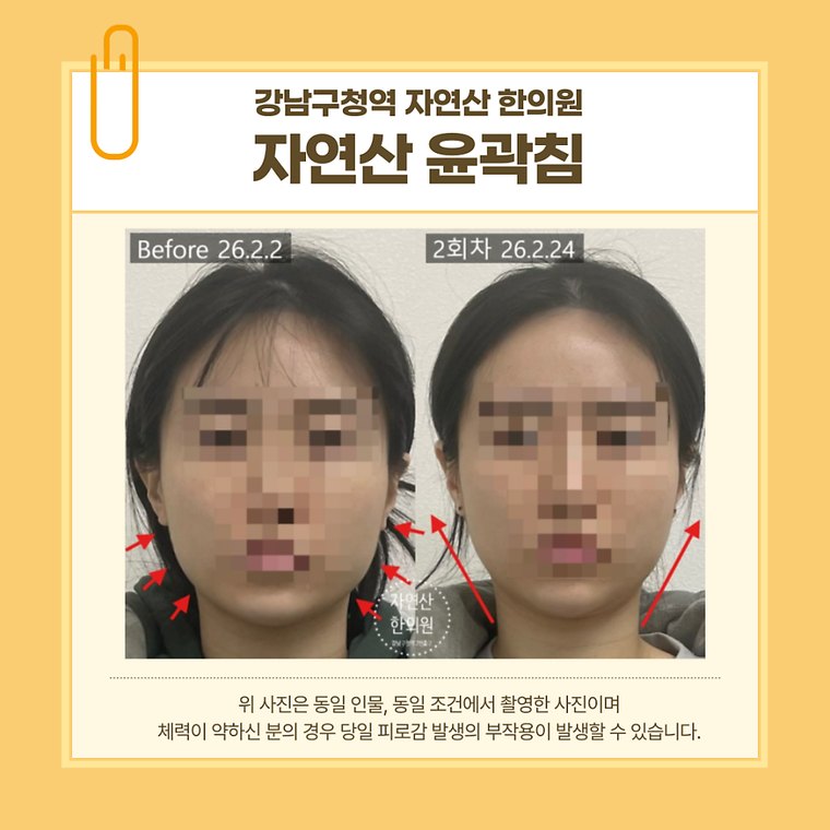 jaw-muscle-reduction 치료 사례 7 — 시술 전후 비교
