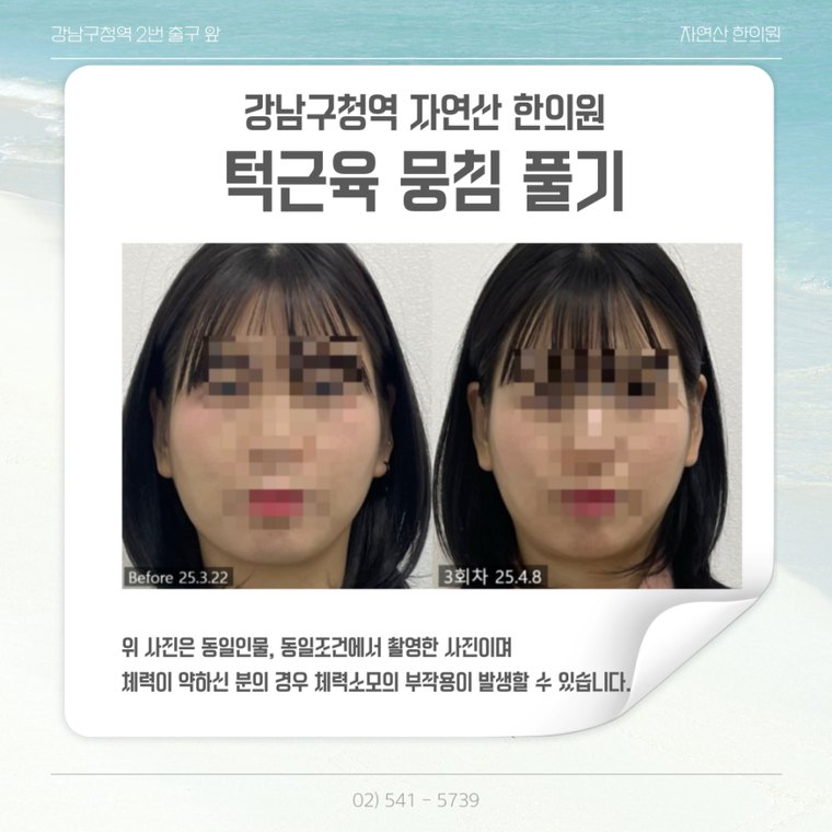 jaw-muscle-release 치료 사례 1 — 시술 전후 비교