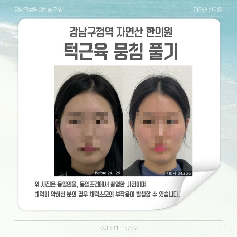 jaw-muscle-release 치료 사례 2 — 시술 전후 비교