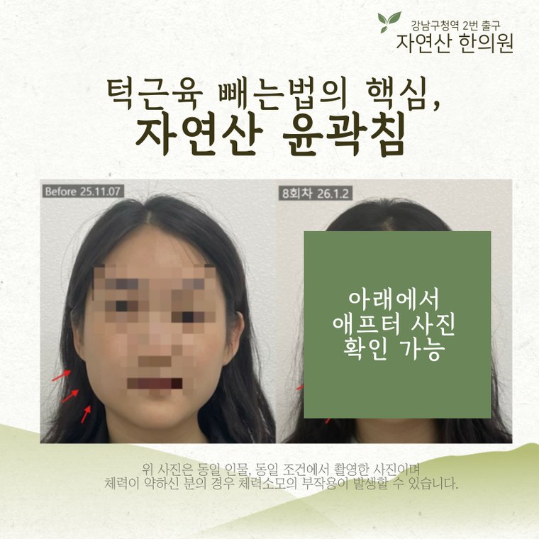 jaw-muscle-shrink 치료 사례 1 — 시술 전후 비교