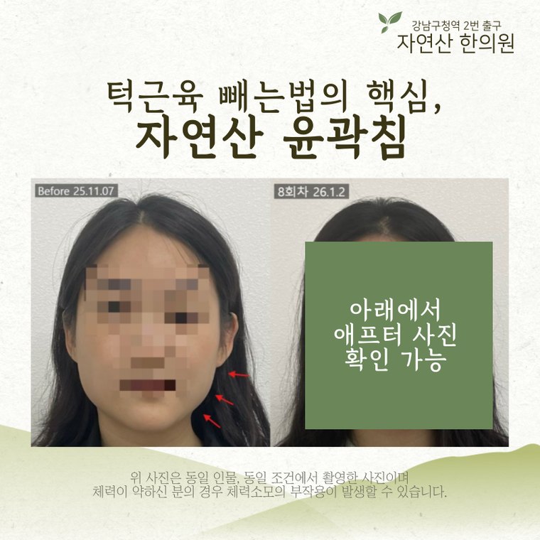 jaw-muscle-shrink 치료 사례 2 — 시술 전후 비교