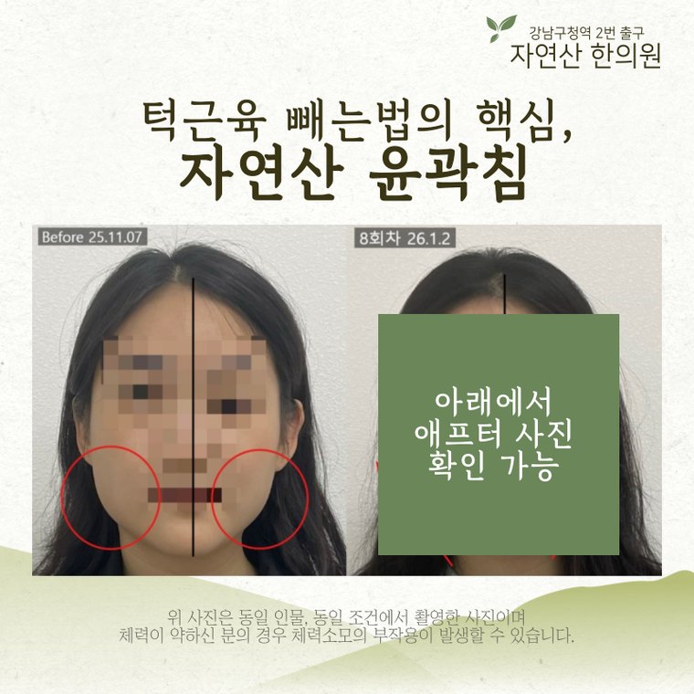jaw-muscle-shrink 치료 사례 3 — 시술 전후 비교