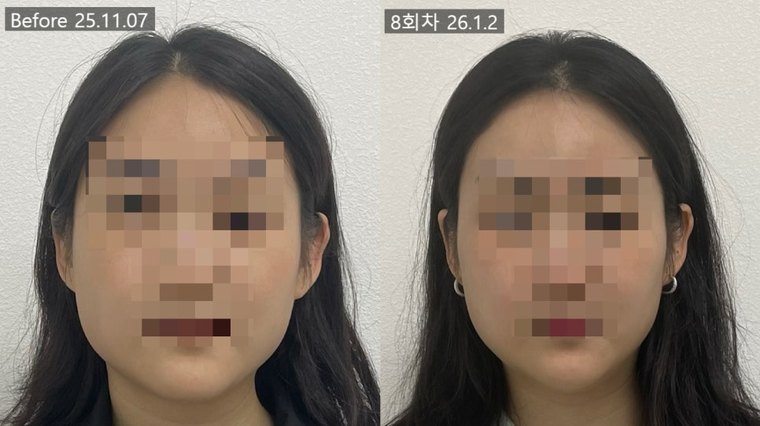 jaw-muscle-shrink 치료 사례 4 — 시술 전후 비교