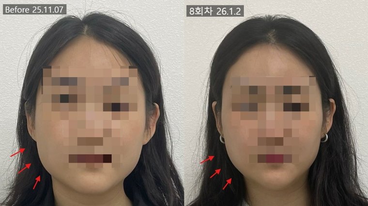 jaw-muscle-shrink 치료 사례 5 — 시술 전후 비교