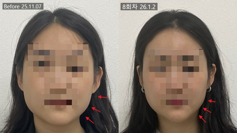 jaw-muscle-shrink 치료 사례 6 — 시술 전후 비교
