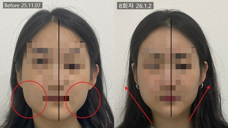 jaw-muscle-shrink 치료 사례 7 — 시술 전후 비교