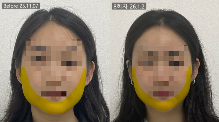 jaw-muscle-shrink 치료 사례 8 — 시술 전후 비교
