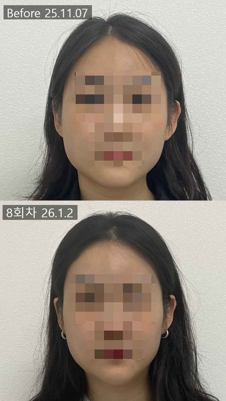 jaw-muscle-shrink 치료 사례 9 — 시술 전후 비교