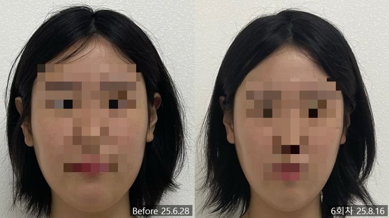 jaw-muscle-tension-release 치료 사례 5 — 시술 전후 비교