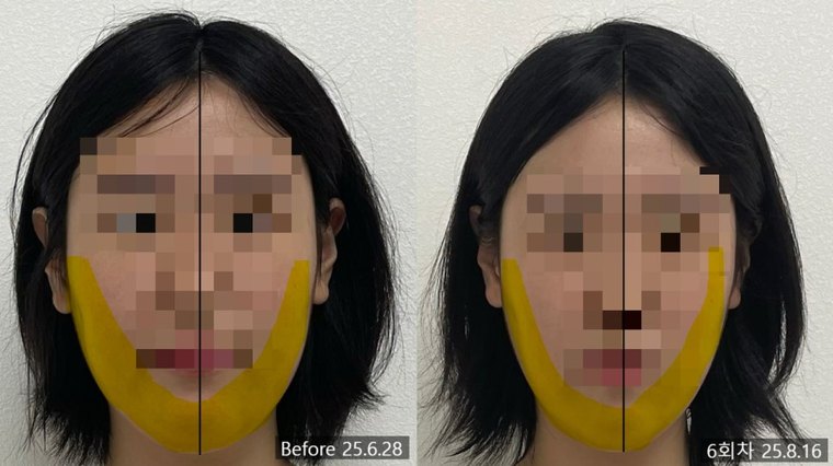 jaw-muscle-tension-release 치료 사례 6 — 시술 전후 비교