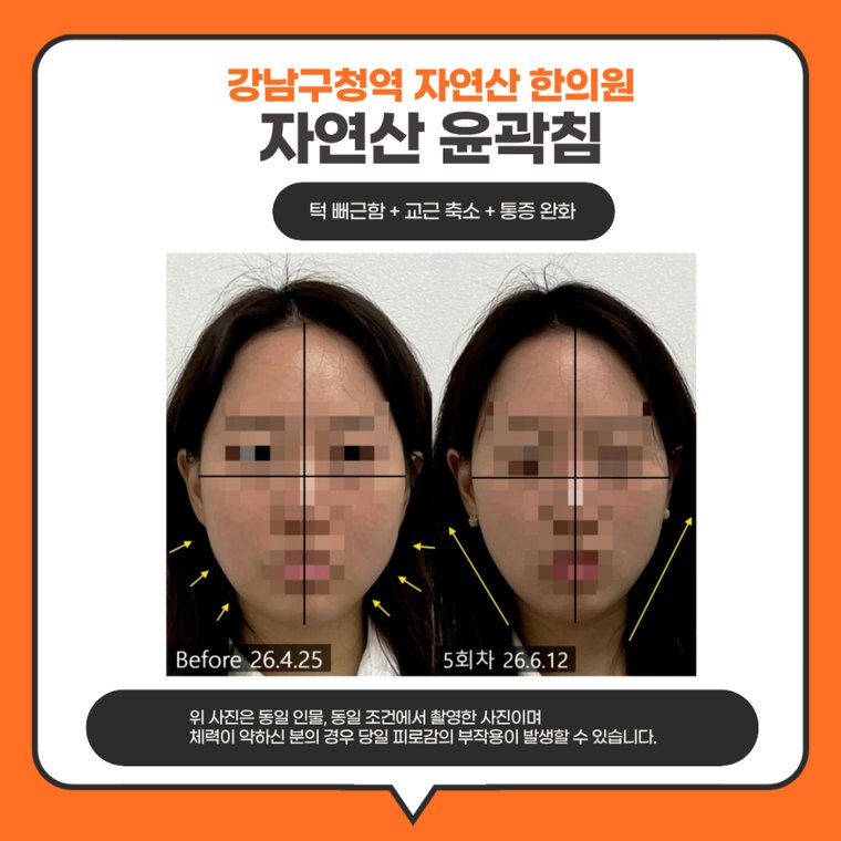 jaw-stiffness-cause 치료 사례 1 — 시술 전후 비교
