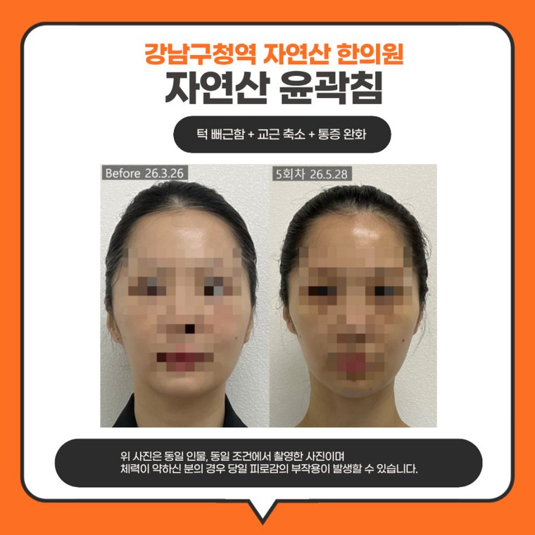 jaw-stiffness-cause 치료 사례 2 — 시술 전후 비교