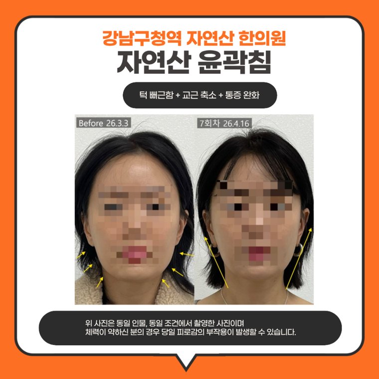 jaw-stiffness-cause 치료 사례 3 — 시술 전후 비교