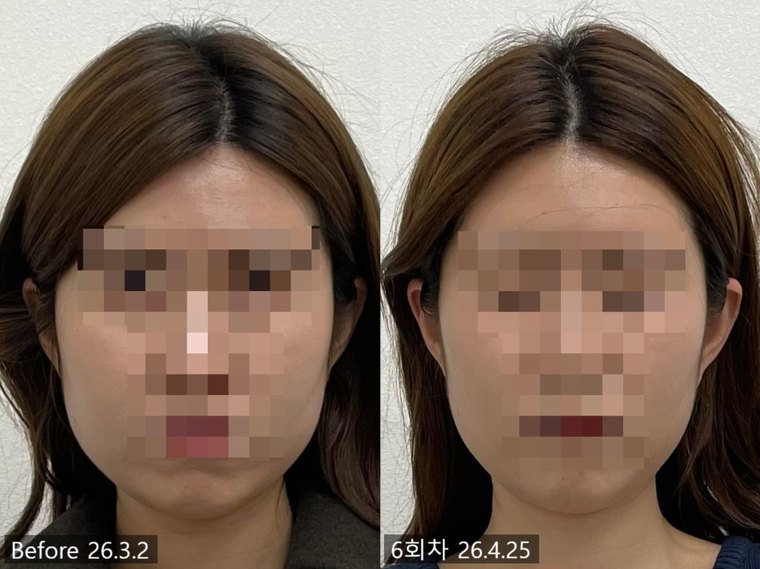 jaw-stiffness-cause 치료 사례 4 — 시술 전후 비교