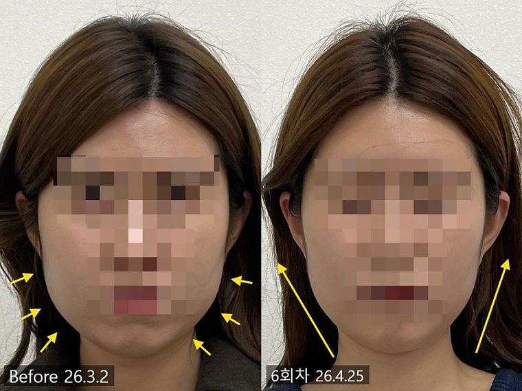 jaw-stiffness-cause 치료 사례 5 — 시술 전후 비교