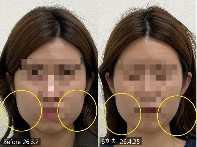 jaw-stiffness-cause 치료 사례 6 — 시술 전후 비교