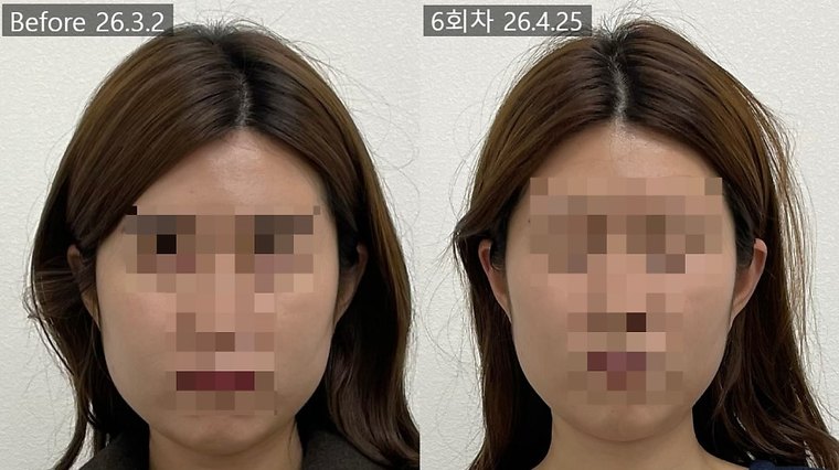 jaw-stiffness-cause 치료 사례 7 — 시술 전후 비교