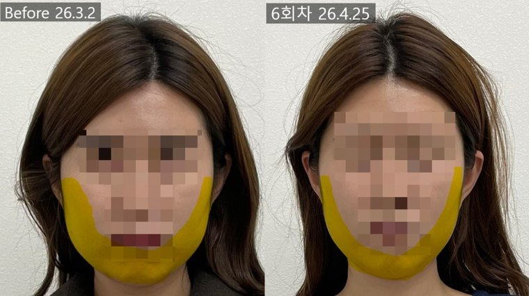 jaw-stiffness-cause 치료 사례 8 — 시술 전후 비교