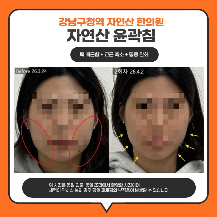 jaw-stiffness-cause 치료 사례 9 — 시술 전후 비교
