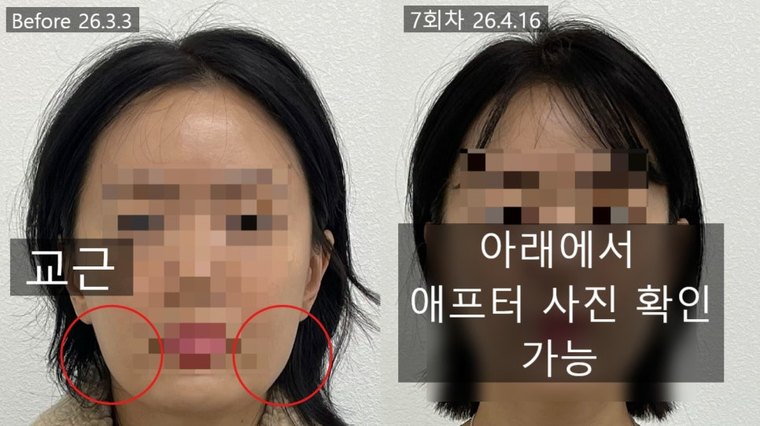 masseter-pain 치료 사례 1 — 시술 전후 비교
