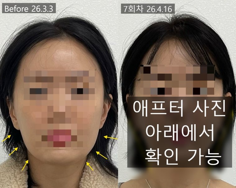 masseter-pain 치료 사례 2 — 시술 전후 비교