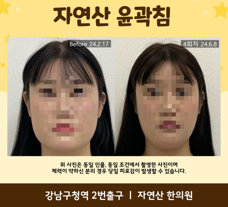 masseter-pain 치료 사례 3 — 시술 전후 비교