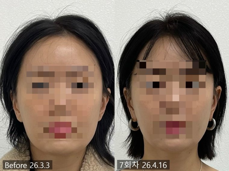 masseter-pain 치료 사례 4 — 시술 전후 비교