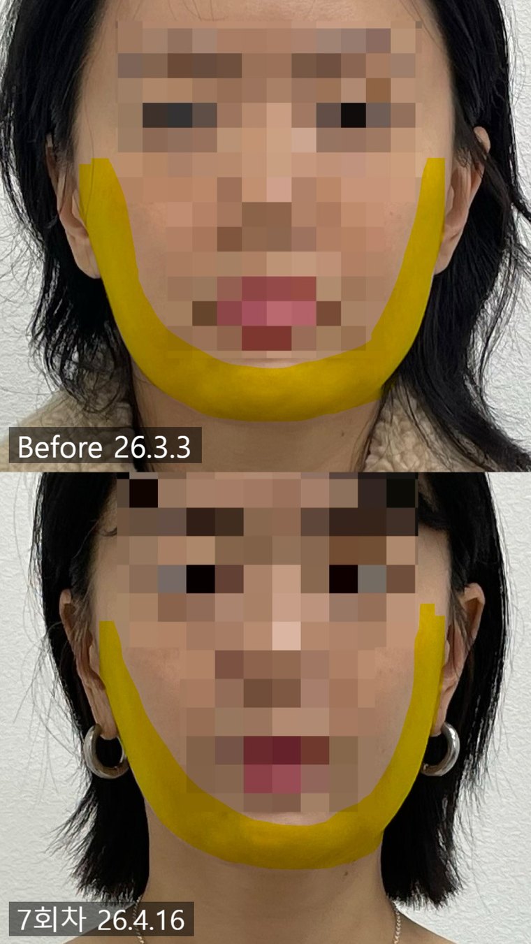 masseter-pain 치료 사례 7 — 시술 전후 비교