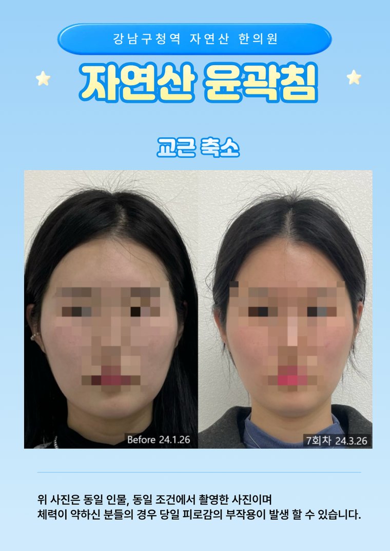 masseter-reduction 치료 사례 1 — 시술 전후 비교
