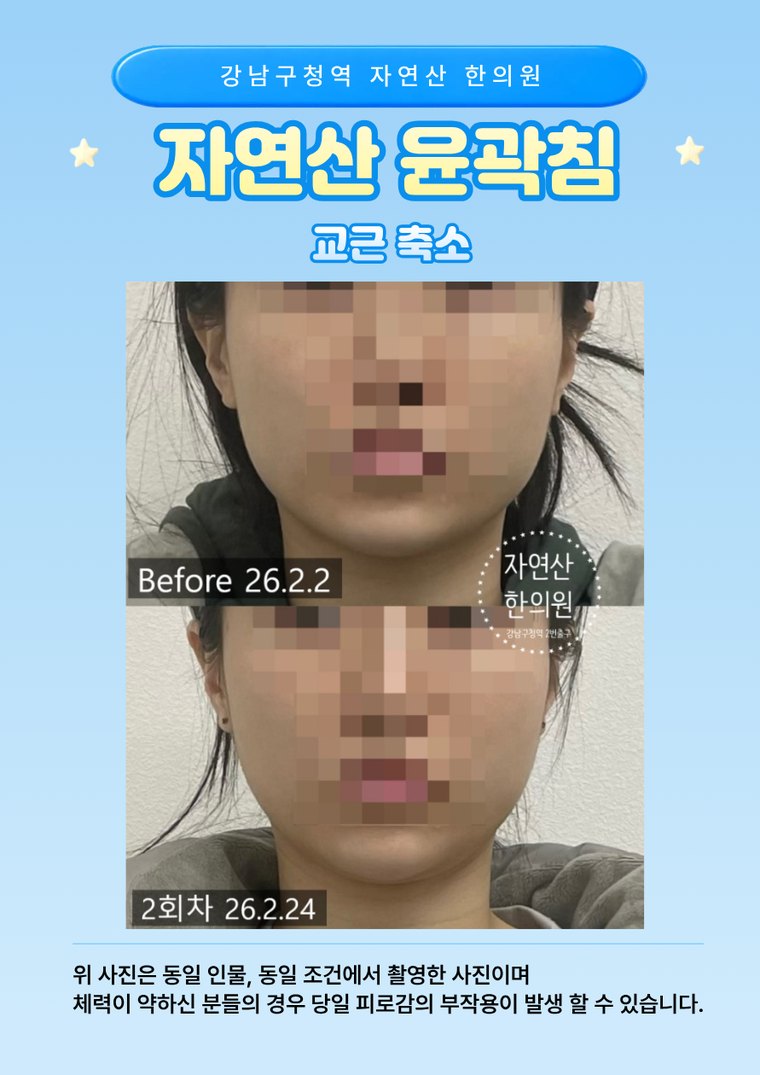 masseter-reduction 치료 사례 2 — 시술 전후 비교