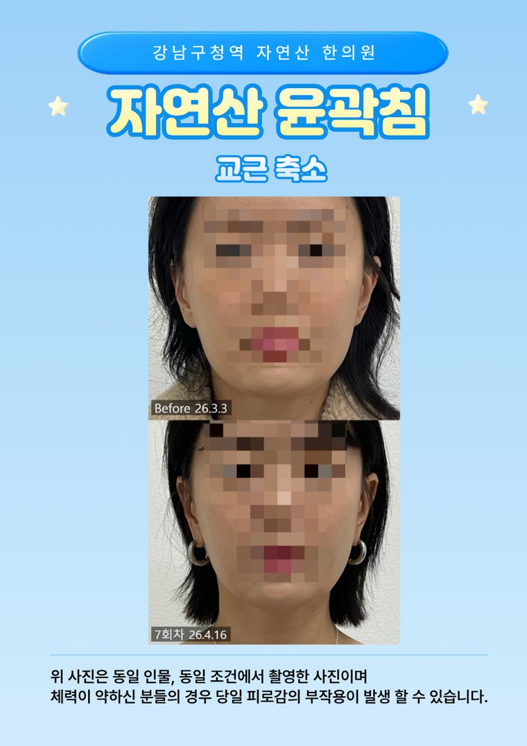 masseter-reduction 치료 사례 3 — 시술 전후 비교