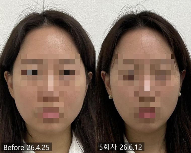 masseter-reduction 치료 사례 4 — 시술 전후 비교