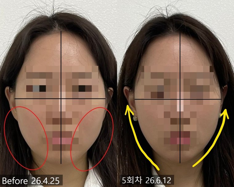 masseter-reduction 치료 사례 5 — 시술 전후 비교