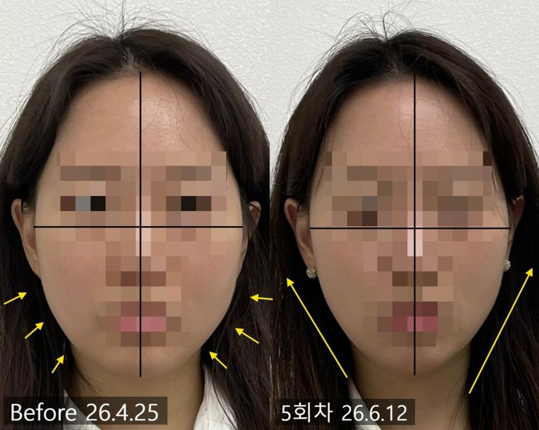masseter-reduction 치료 사례 6 — 시술 전후 비교