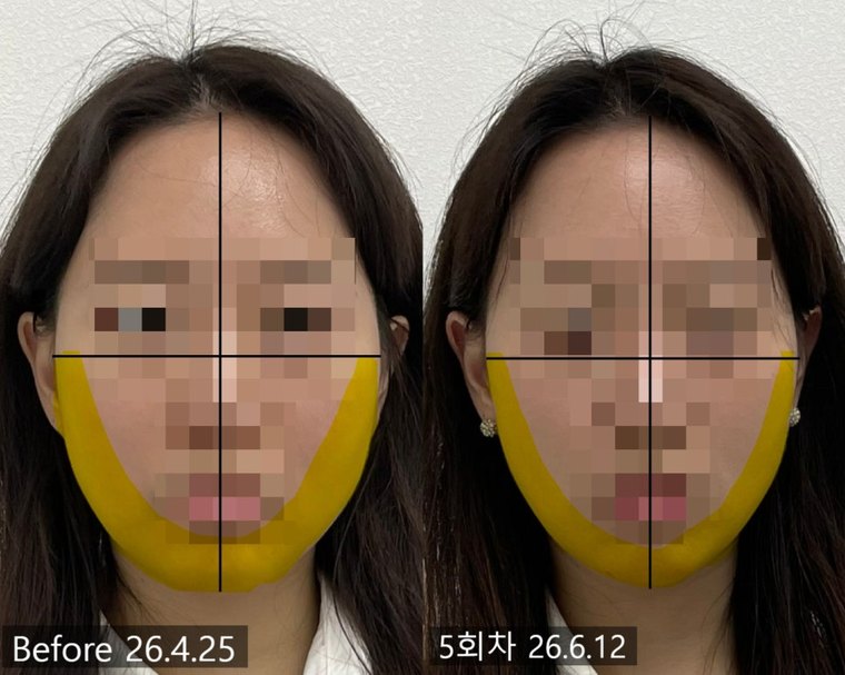 masseter-reduction 치료 사례 7 — 시술 전후 비교