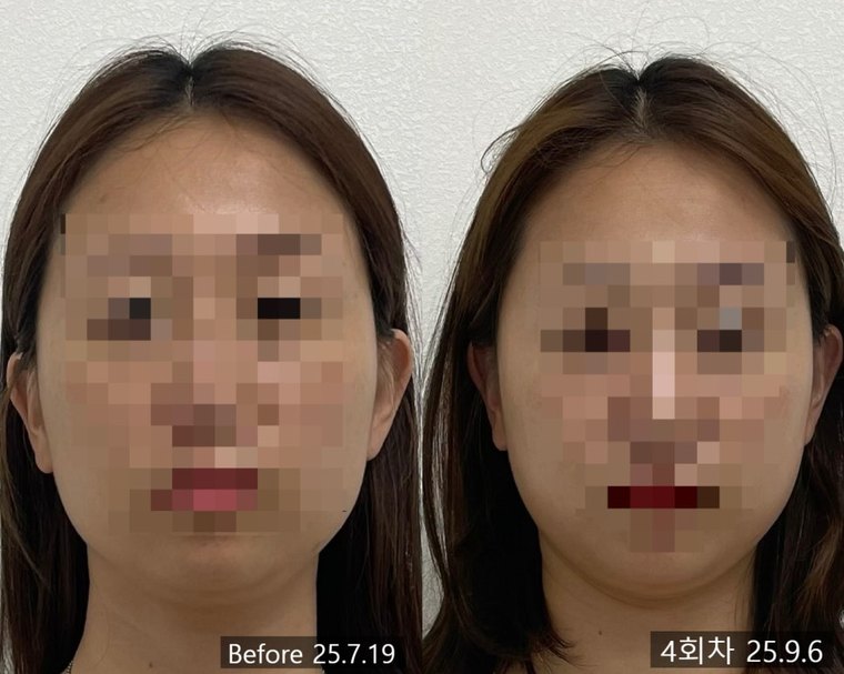 masseter-reduction-procedure 치료 사례 1 — 시술 전후 비교