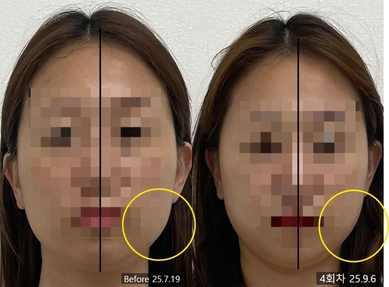 masseter-reduction-procedure 치료 사례 2 — 시술 전후 비교
