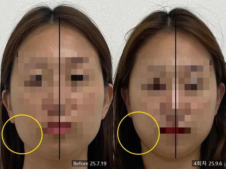 masseter-reduction-procedure 치료 사례 3 — 시술 전후 비교
