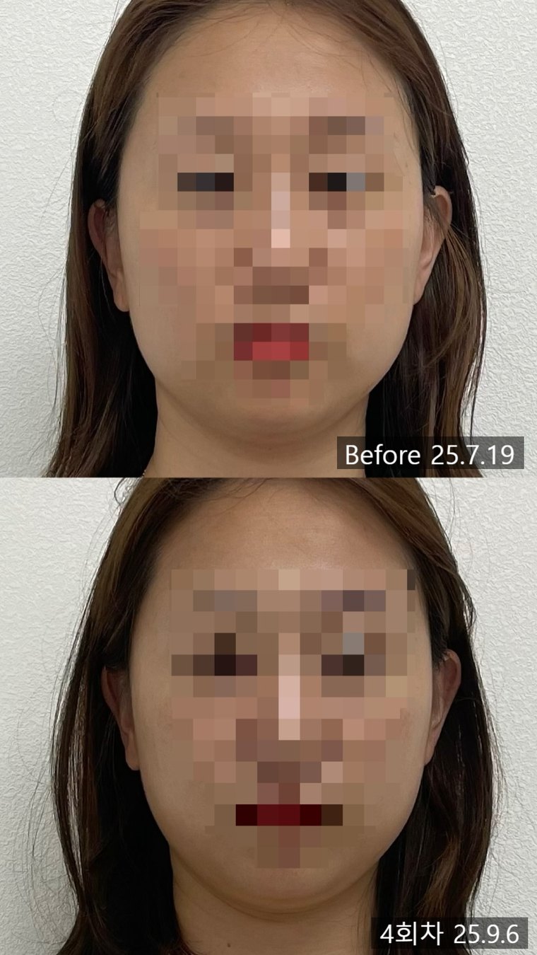 masseter-reduction-procedure 치료 사례 4 — 시술 전후 비교