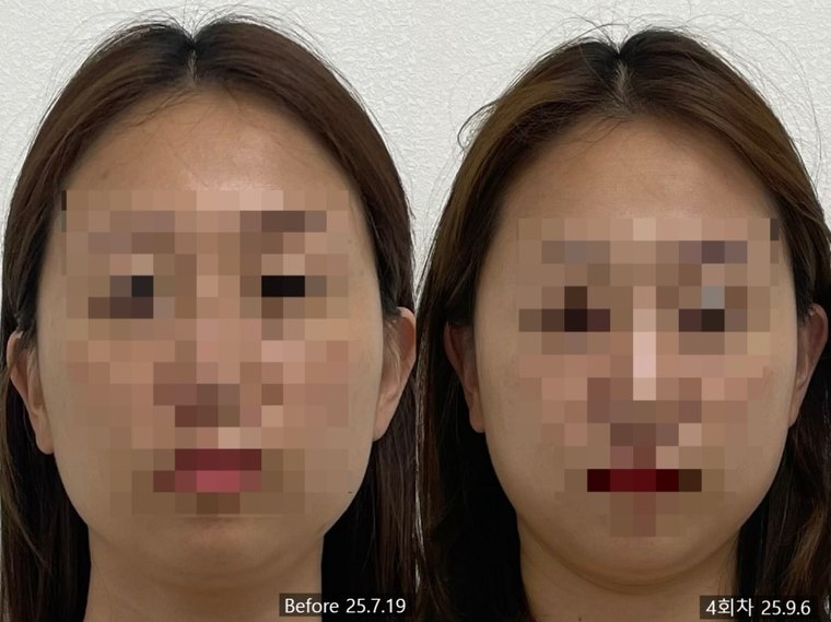masseter-reduction-procedure 치료 사례 5 — 시술 전후 비교