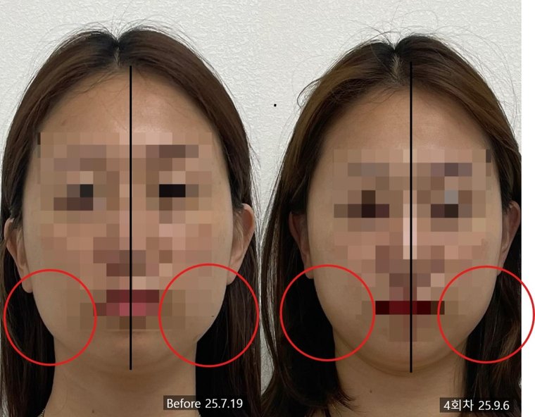 masseter-reduction-procedure 치료 사례 6 — 시술 전후 비교