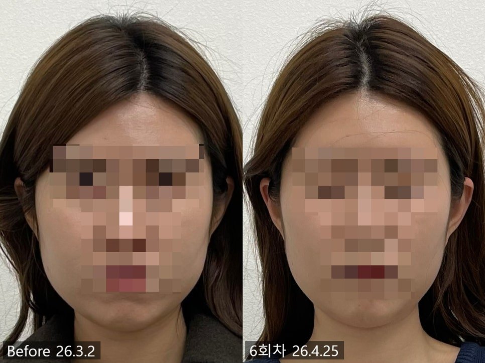 자연산 윤곽침 6회차 정면 전후 비교 — 동일 인물·동일 조건에서 촬영한 보정 없는 원본