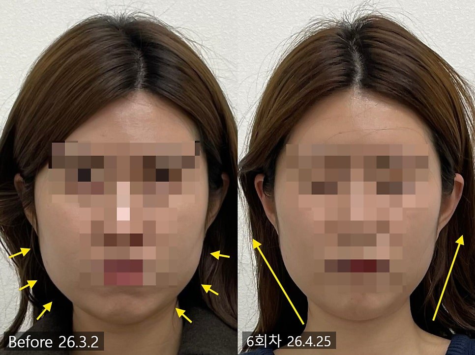 턱선이 좁아진 방향을 화살표로 표시한 6회차 전후 비교 — 보정 없는 원본