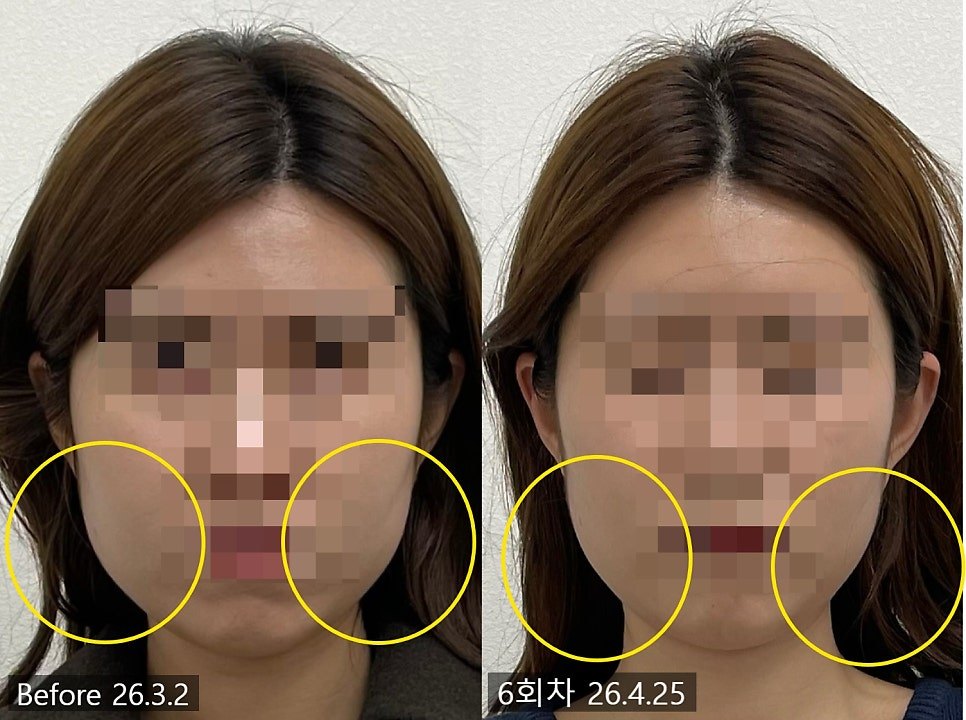 볼과 턱의 교근 구역을 원으로 표시한 6회차 전후 비교 — 보정 없는 원본