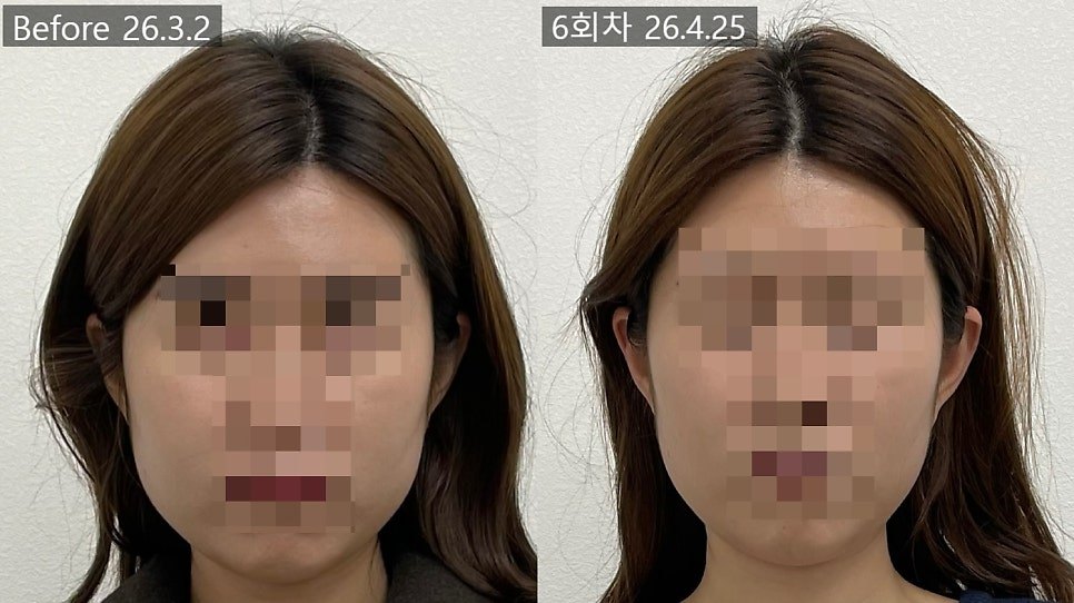 회차 라벨만 붙인 6회차 전후 비교 — 표시선 없는 보정 없는 원본