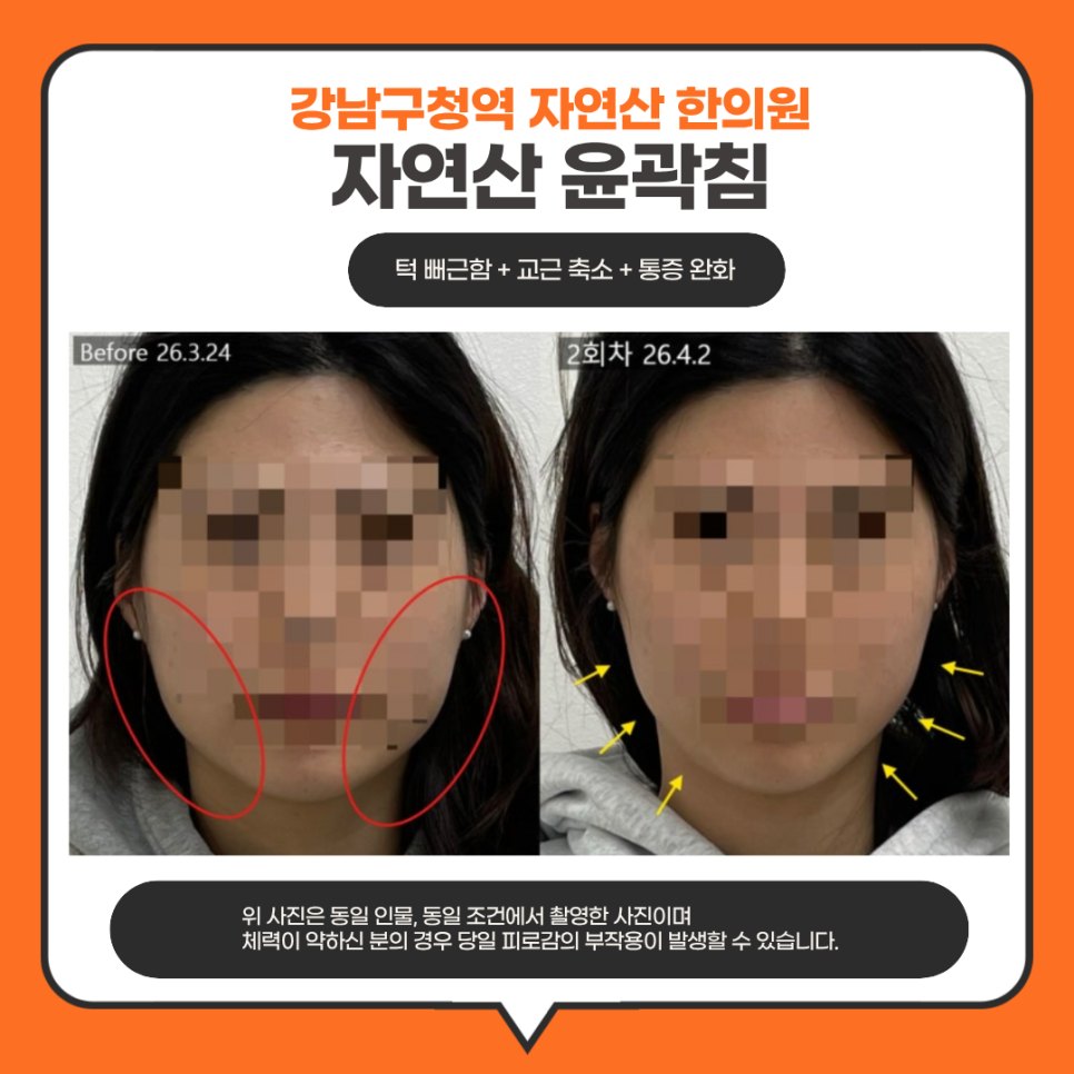다른 분의 2회차 전후 비교와 고지문구가 함께 들어간 이미지 — 보정 없는 원본